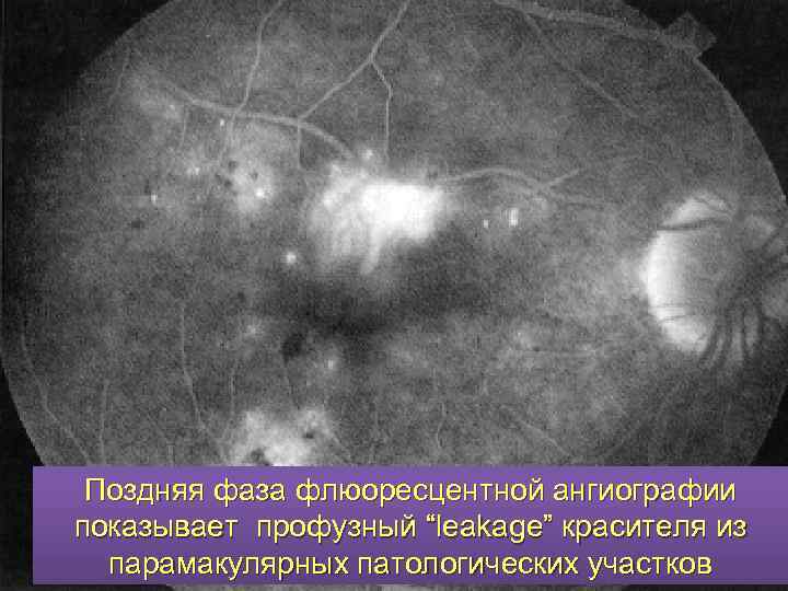 Поздняя фаза флюоресцентной ангиографии показывает профузный “leakage” красителя из парамакулярных патологических участков 