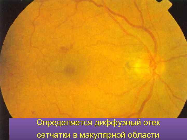 Определяется диффузный отек сетчатки в макулярной области 