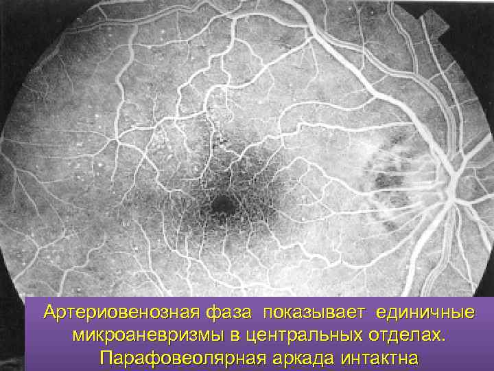 Артериовенозная фаза показывает единичные микроаневризмы в центральных отделах. Парафовеолярная аркада интактна 