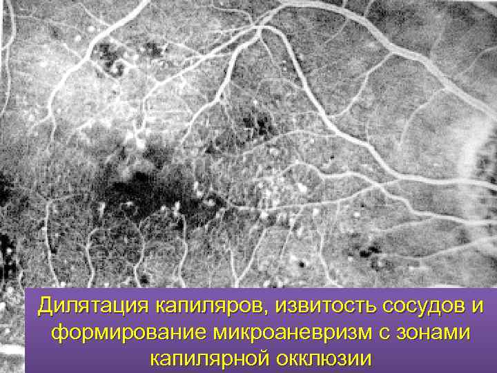Дилятация капиляров, извитость сосудов и формирование микроаневризм с зонами капилярной окклюзии 
