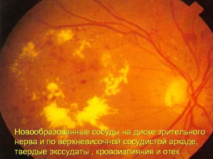 Новообразованные сосуды на диске зрительного нерва и по верхневисочной сосудистой аркаде, твердые экссудаты ,