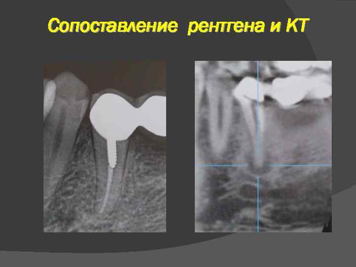 Сопоставление рентгена и КТ 