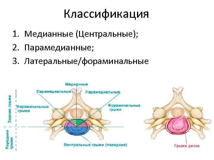 Классификация 1. Медианные (Центральные); 2. Парамедианные; 3. Латеральные/фораминальные 