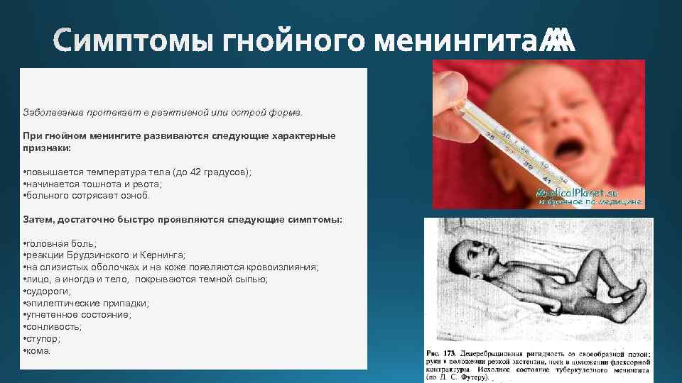  Заболевание протекает в реактивной или острой форме. При гнойном менингите развиваются следующие характерные