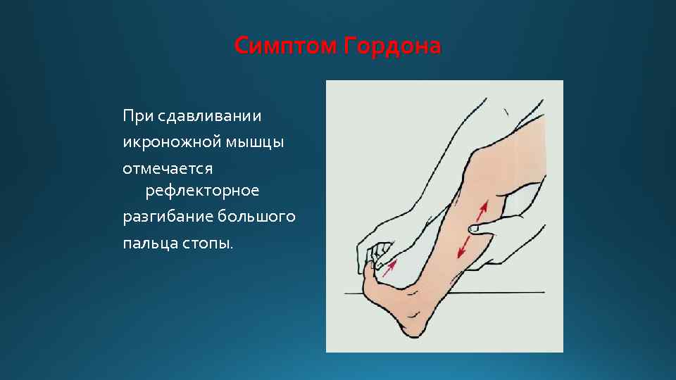 Симптом Гордона При сдавливании икроножной мышцы отмечается рефлекторное разгибание большого пальца стопы. 