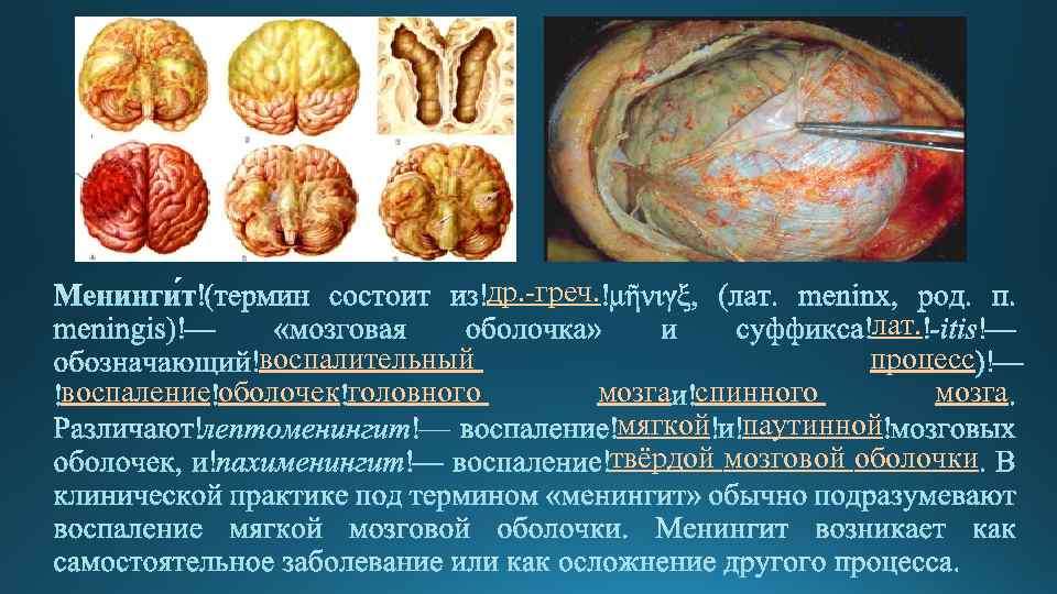 др. -греч. воспалительный воспаление оболочек головного лат. процесс мозга спинного мозга мягкой паутинной твёрдой