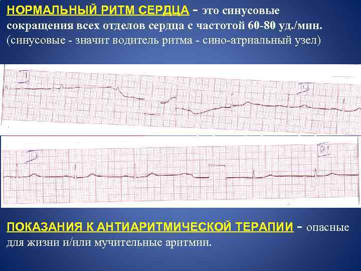 НОРМАЛЬНЫЙ РИТМ СЕРДЦА - это синусовые сокращения всех отделов сердца с частотой 60 -80