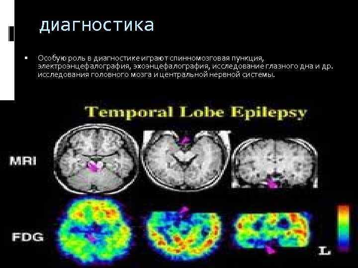 диагностика Особую роль в диагностике играют спинномозговая пункция, электроэнцефалография, эхоэнцефалография, исследование глазного дна и