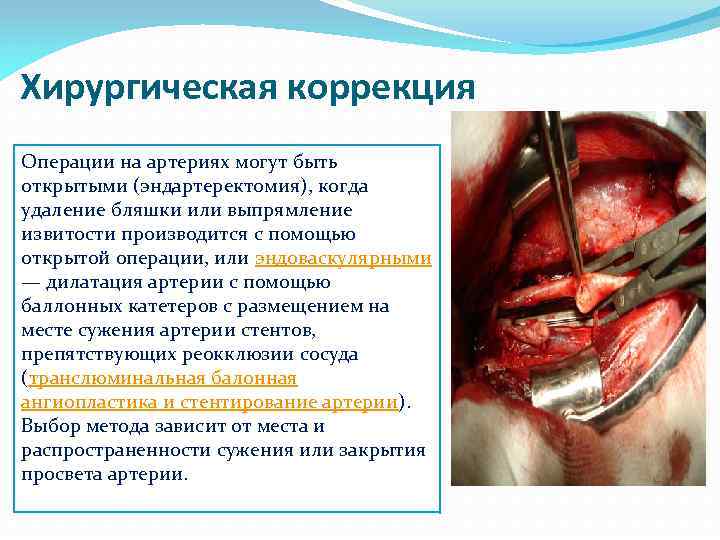 Хирургическая коррекция Операции на артериях могут быть открытыми (эндартеректомия), когда удаление бляшки или выпрямление