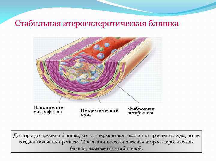 Стабильная атеросклеротическая бляшка Накопление макрофагов Некротический очаг Фиброзная покрышка До поры до времени бляшка,