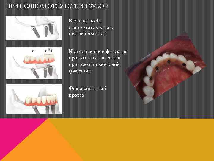 ПРИ ПОЛНОМ ОТСУТСТВИИ ЗУБОВ Вживление 4 х имплантатов в тело нижней челюсти Изготовление и