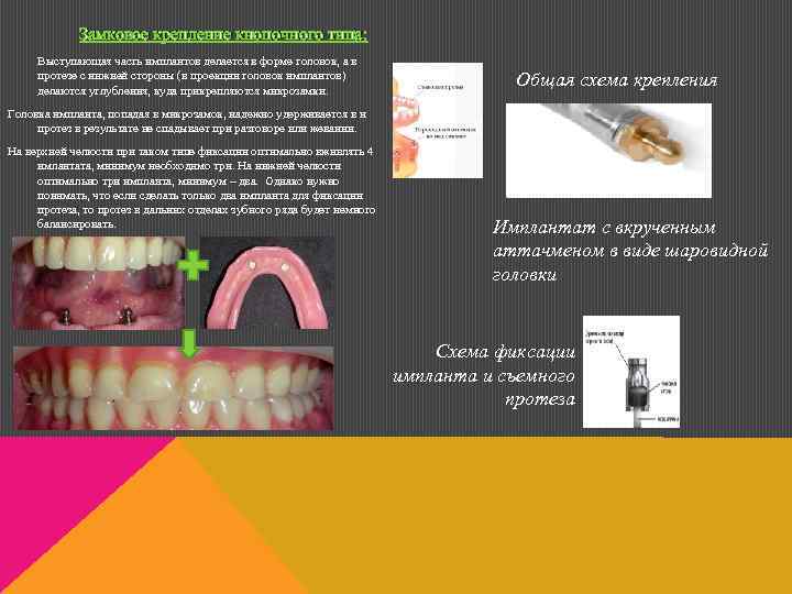 Замковое крепление кнопочного типа: Выступающая часть имплантов делается в форме головок, а в протезе