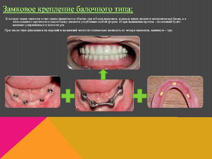 Замковое крепление балочного типа: В косную ткань челюсти точно также вживляются обычно три и