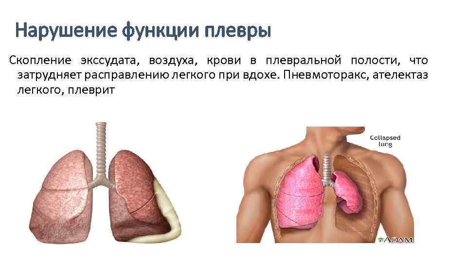 Плевральное дыхание. Нарушение функции плевры пневмоторакс. Причины нарушения функции плевры. Легкие и плевральная полость. Строение легких плевральная полость.