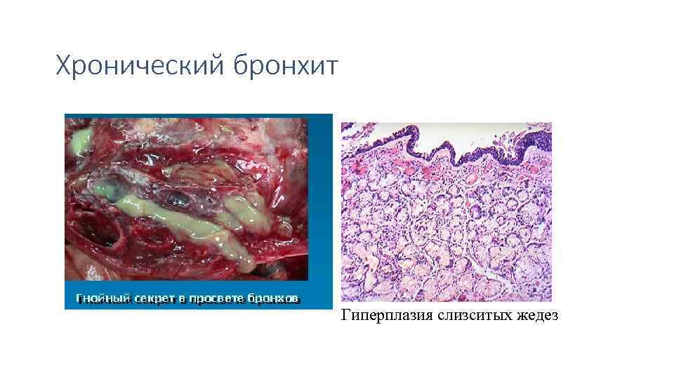 Хронический бронхит Гиперплазия слизситых жедез 