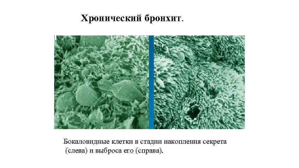 Хронический бронхит. Бокаловидные клетки в стадии накопления секрета (слева) и выброса его (справа). 