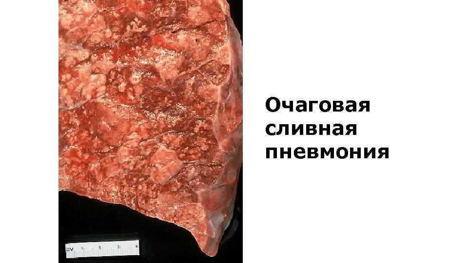 Очаговая сливная пневмония 