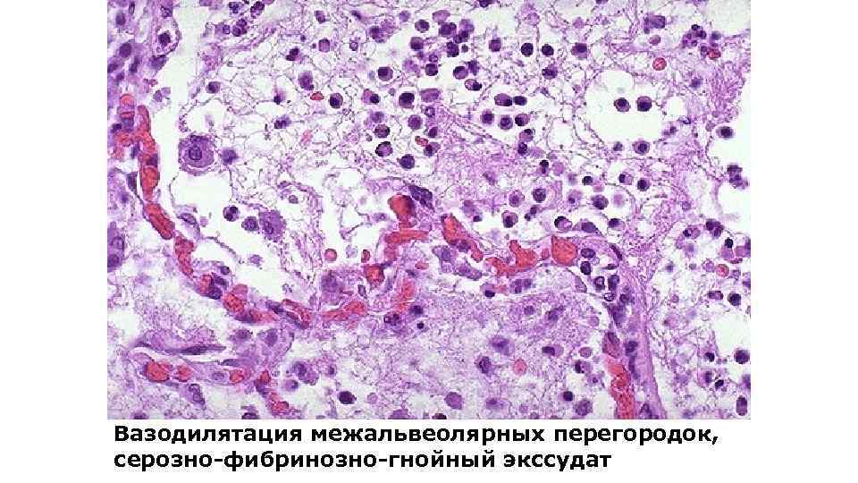 Вазодилятация межальвеолярных перегородок, серозно-фибринозно-гнойный экссудат 