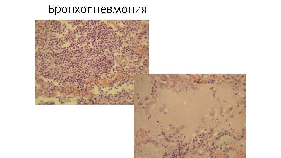 Бронхопневмония карта вызова