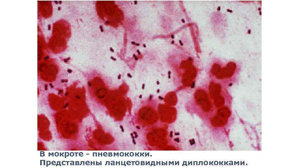 В мокроте - пневмококки. Представлены ланцетовидными диплококками. 