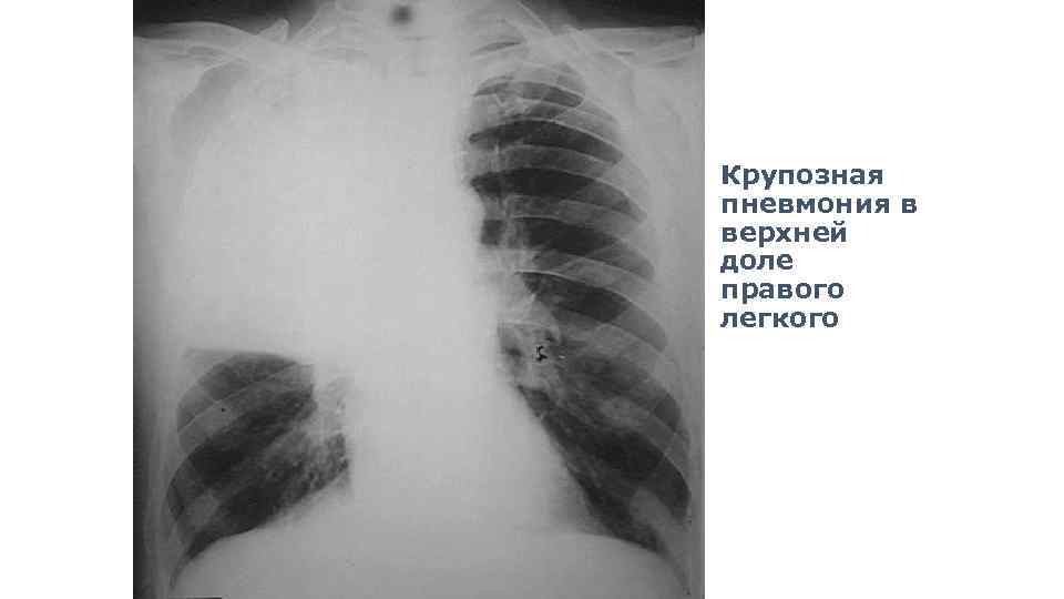 Крупозная пневмония в верхней доле правого легкого 