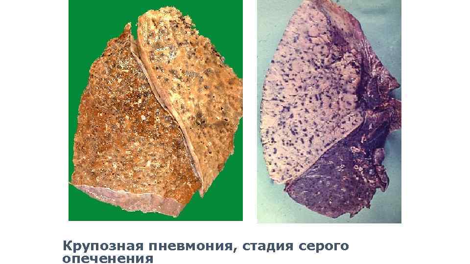 Крупозная пневмония. Крупозная пневмония стадия красного опеченения. Крупозная пневмония стадия серого опеченения. Серое опеченение крупозной пневмонии.