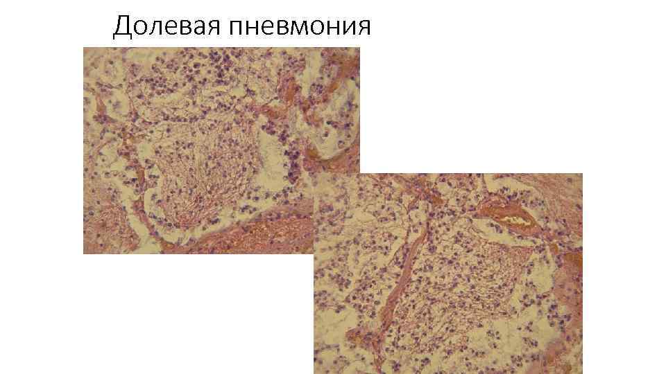 Долевая пневмония. Долевая пневмония препарат. Абсцесс легкого и долевая пневмония. Морфология долевой пневмонии. Карнификация при долевой пневмонии микропрепарат.