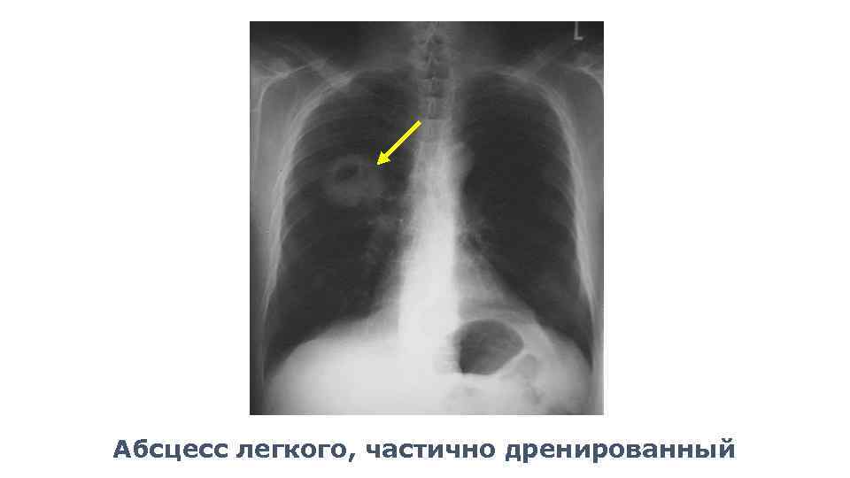 Бронхогенный абсцесс легкого. Абсцесс легкого рентгенограмма. Дренированный абсцесс легкого.