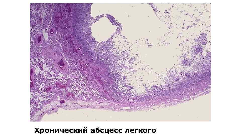 Хронический абсцесс легкого 