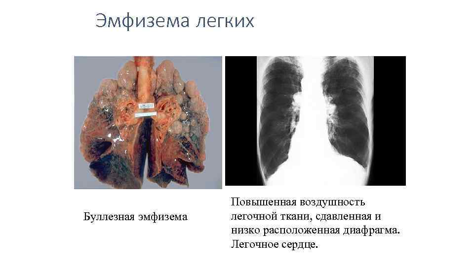 Эмфизема легких Буллезная эмфизема Повышенная воздушность легочной ткани, сдавленная и низко расположенная диафрагма. Легочное