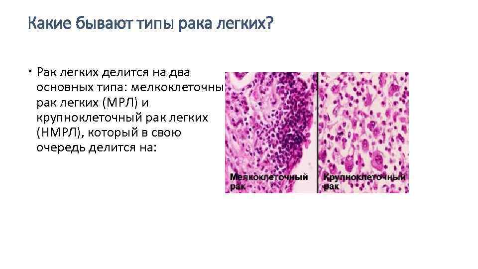 Какие бывают типы рака легких? Рак легких делится на два основных типа: мелкоклеточный рак