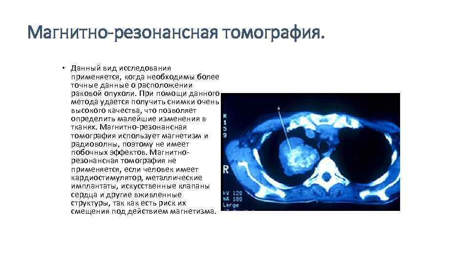 Магнитно-резонансная томография. Данный вид исследования применяется, когда необходимы более точные данные о расположении раковой