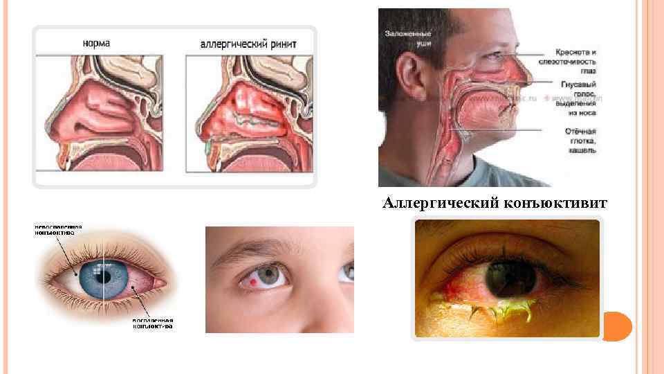 Аллергический конъюктивит 