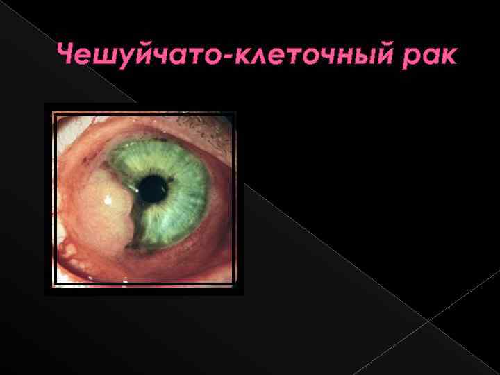 Чешуйчато-клеточный рак 