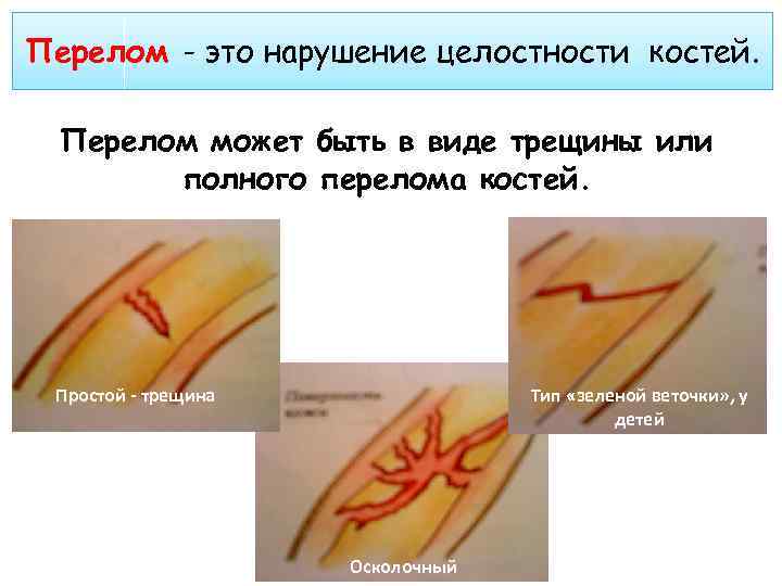 Перелом - это нарушение целостности костей. Перелом может быть в виде трещины или полного