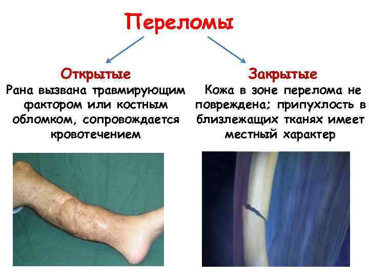 Переломы Открытые Закрытые Рана вызвана травмирующим Кожа в зоне перелома не фактором или костным