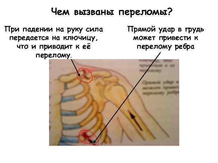 Чем вызваны переломы? При падении на руку сила передается на ключицу, что и приводит