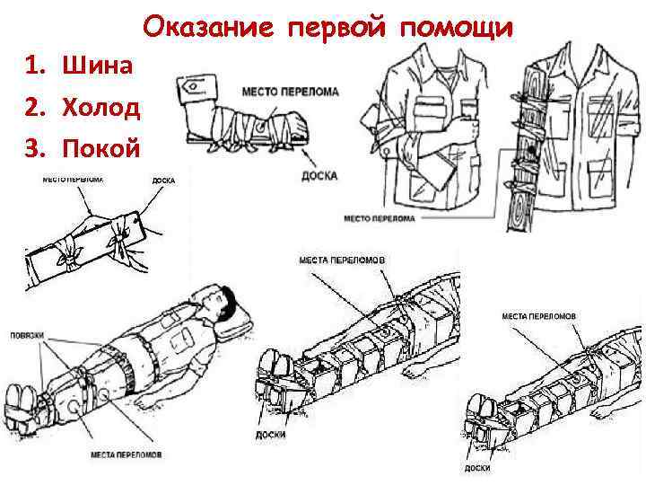 Оказание первой помощи 1. Шина 2. Холод 3. Покой 