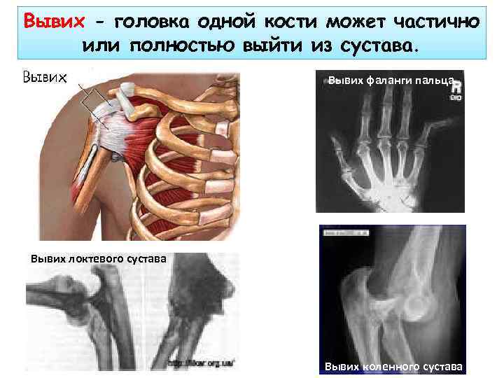 Вывих - головка одной кости может частично или полностью выйти из сустава. Вывих фаланги