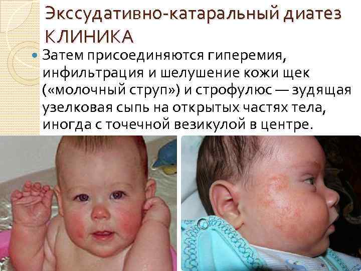 Диатез экссудативно катаральный фото