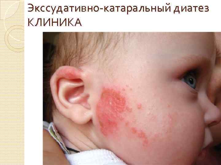 Экссудативно катаральный диатез КЛИНИКА 