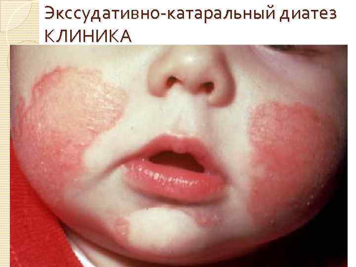 Экссудативно катаральный диатез КЛИНИКА 