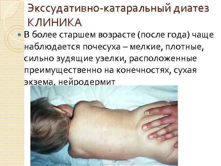 Экссудативно катаральный диатез КЛИНИКА В более старшем возрасте (после года) чаще наблюдается почесуха –