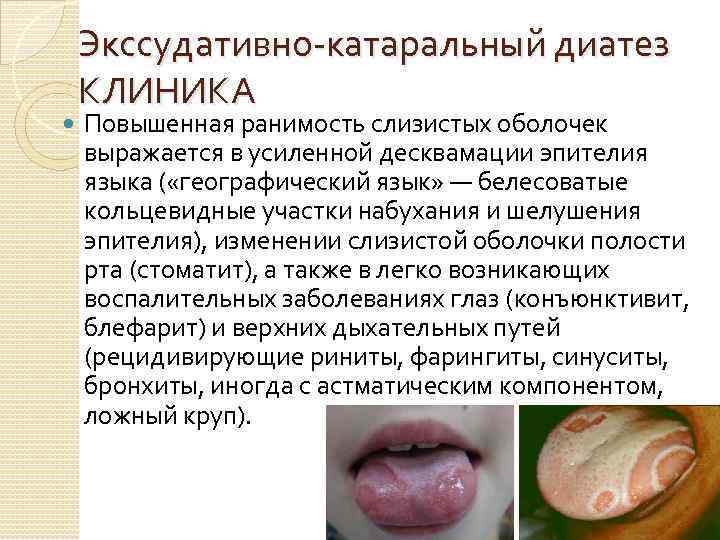  Экссудативно катаральный диатез КЛИНИКА Повышенная ранимость слизистых оболочек выражается в усиленной десквамации эпителия