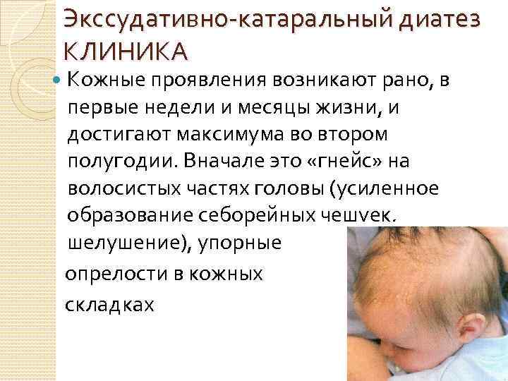 Экссудативно катаральный диатез картинки