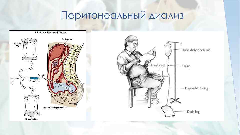 Перитонеальный диализ презентация