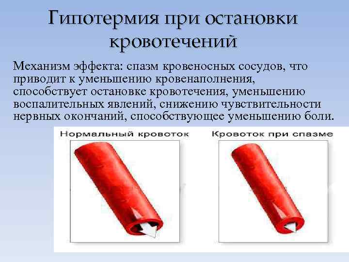 Гипотермия при остановки кровотечений Механизм эффекта: спазм кровеносных сосудов, что приводит к уменьшению кровенаполнения,