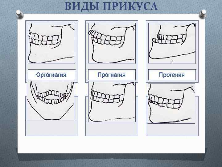 ВИДЫ ПРИКУСА Ортогнатия Прогения 