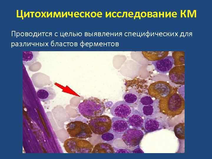 Появление в периферической крови бластов на фоне нормальной лейкоформулы характерно для