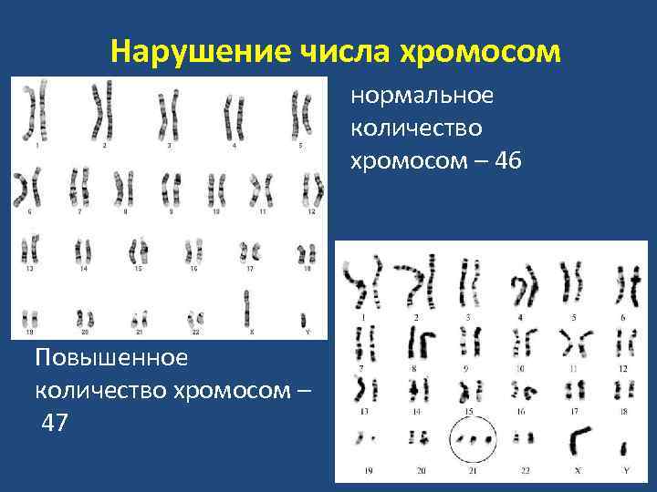 Нормальные числа. Нарушение количества хромосом. Нарушение числа половых хромосом. Хромосомные числа. Числовые хромосомные нарушения.